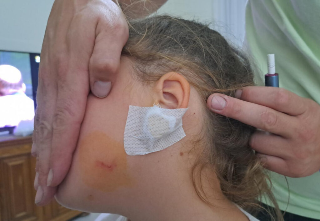 Укусы собаки на теле ребенка